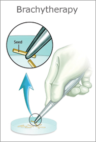 Brachytherapy, prostate cancer treatment